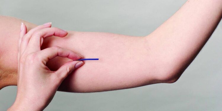 Contraceptivo de longa duração, Implanon entra na cobertura dos planos de saúde.